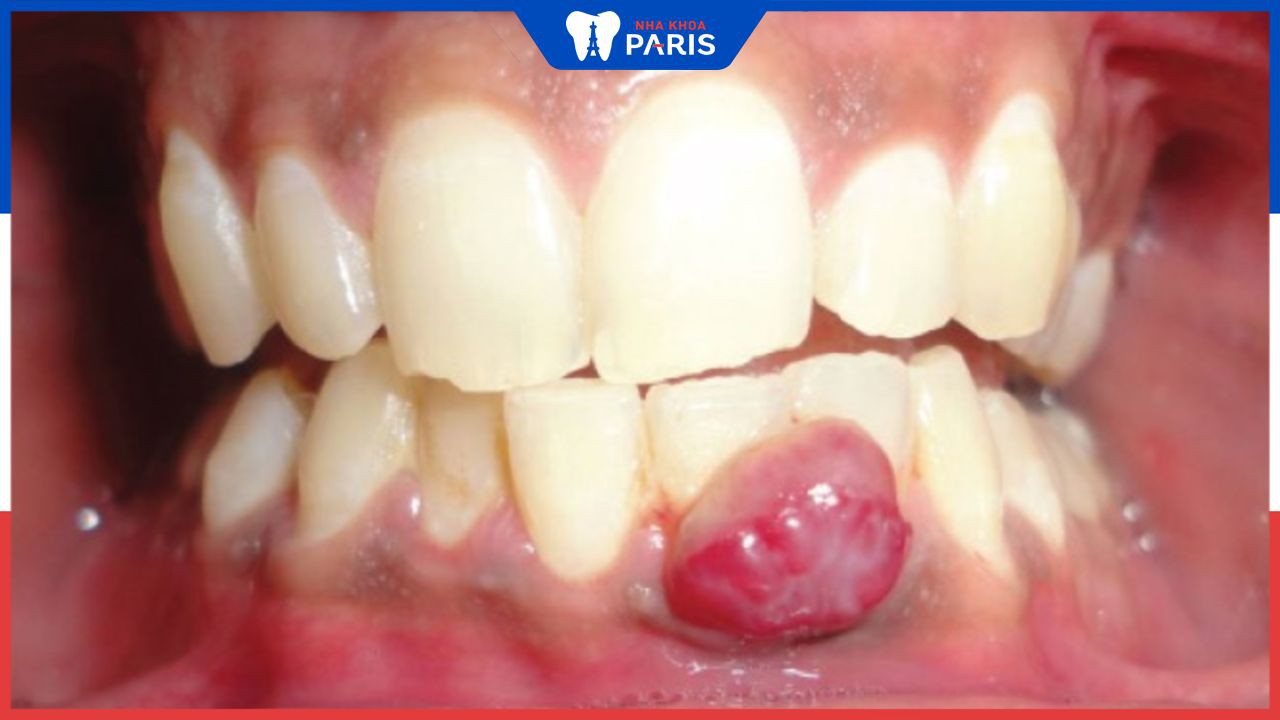 Viêm tủy răng có mủ: Nguyên nhân và cách điều trị hiệu quả